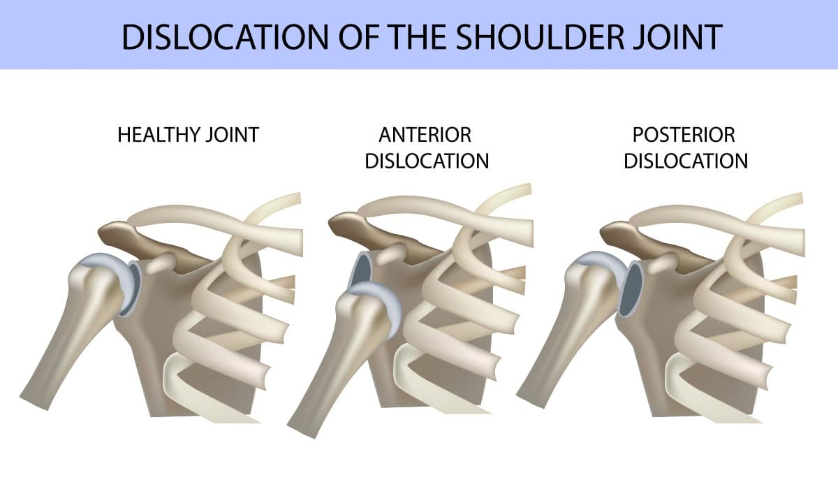 Shoulder Dislocation Treatment Doctor in Chembur
